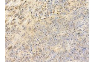 ABIN6255708 and ABIN6267391 at 1/100 staining human melanoma by IHC-P.