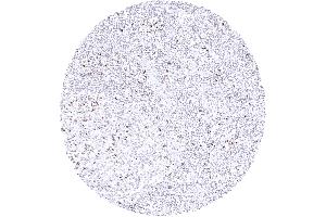 Tonsil Normal tonsil with CTLA 4 staining of a subset of lymphocytes