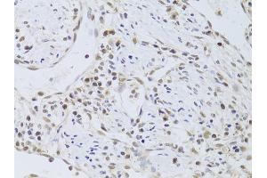 Immunohistochemistry of paraffin-embedded human gastric cancer using FKBP4 Antibody (ABIN5973289) at dilution of 1/100 (40x lens). (FKBP4 anticorps)