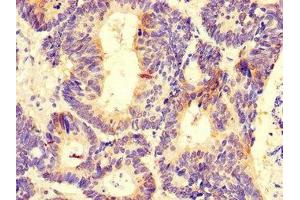 Immunohistochemistry of paraffin-embedded human colon cancer using ABIN7164372 at dilution of 1:100 (DDX6 anticorps  (AA 1-149))