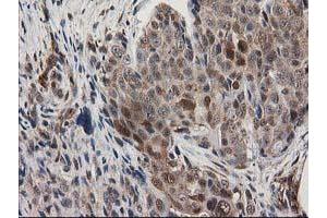 Immunohistochemical staining of paraffin-embedded Adenocarcinoma of Human breast tissue using anti-MAPRE2 mouse monoclonal antibody. (MAPRE2 anticorps)