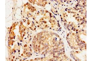 Immunohistochemistry of paraffin-embedded human prostate cancer using ABIN7154893 at dilution of 1:100 (HSF2 anticorps  (AA 79-173))