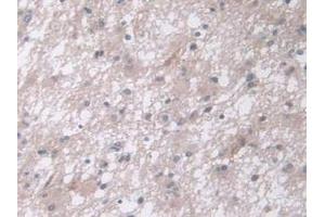 IHC-P analysis of Human Glioma Tissue, with DAB staining. (CPA4 anticorps  (AA 55-421))