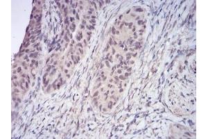 Immunohistochemical analysis of paraffin-embedded human cervical cancer tissues using HDAC2 mouse mAb with DAB staining. (HDAC2 anticorps  (AA 217-327))