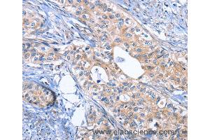 Immunohistochemistry of Human cervical cancer using INHBC Polyclonal Antibody at dilution of 1:50 (INHBC anticorps)