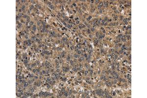 Immunohistochemistry of Human liver cancer using KCNN4 Polyclonal Antibody at dilution of 1:40 (KCNN4 anticorps)