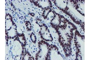 Immunohistochemical staining of paraffin-embedded Adenocarcinoma of Human colon tissue using anti-METT10D mouse monoclonal antibody. (METTL16 anticorps)