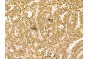 ABIN6262615 and ABIN6269090 at 1/100 staining human renal cell carcinoma by IHC-P. (Integrin beta 3 anticorps  (C-Term))