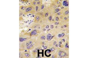 Formalin-fixed and paraffin-embedded human hepatocellular carcinoma reacted with PFKFB1 polyclonal antibody  , which was peroxidase-conjugated to the secondary antibody, followed by DAB staining. (PFKFB1 anticorps  (N-Term))