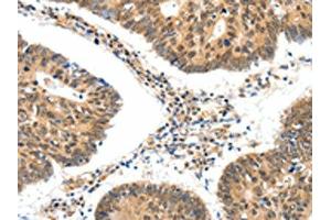 The image on the left is immunohistochemistry of paraffin-embedded Human colon cancer tissue using ABIN7192661(SSTR5 Antibody) at dilution 1/30, on the right is treated with synthetic peptide.