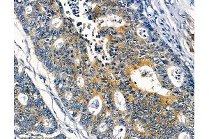 ABIN6256861 and ABIN6273953 at 1/100 staining human prostate cancer and adjacent non-tumor tissue by IHC-P. (NPY4R anticorps  (N-Term))