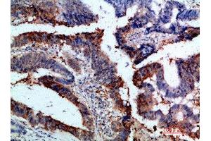 Immunohistochemical analysis of paraffin-embedded human-colon-cancer, antibody was diluted at 1:200 (Integrin alpha 1 anticorps  (AA 920-980))