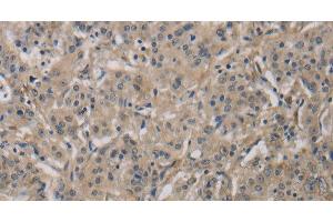 Immunohistochemistry of paraffin-embedded Human gastric cancer tissue using DCN Polyclonal Antibody at dilution 1:30