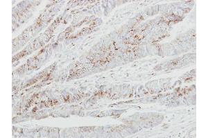 IHC-P Image Immunohistochemical analysis of paraffin-embedded human colon carcinoma, using GALNT2, antibody at 1:250 dilution.