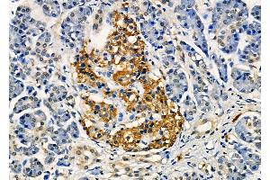 ABIN6262062 and ABIN6272310 at 1/100 staining Human pancreatic cancer and adjacent non-tumor tissue by IHC-P.