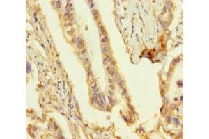 Immunohistochemistry of paraffin-embedded human pancreatic cancer using ABIN7162135 at dilution of 1:100 (OBP2A anticorps  (AA 16-170))