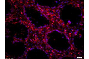 Formalin-fixed and paraffin embedded human colon carcinoma labeled with Anti-LSP1 Polyclonal Antibody, Unconjugated (ABIN755632) at 1:200 followed by conjugation to the secondary antibody Goat Anti-Rabbit IgG,PE conjugated used at 1:200 dilution for 40 minutes at 37°C and DAPI staining