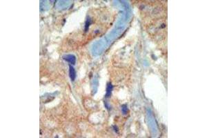 Formalin-fixed and paraffin-embedded human cancer tissue reacted with the primary antibody, which was peroxidase-conjugated to the secondary antibody, followed by DAB staining.