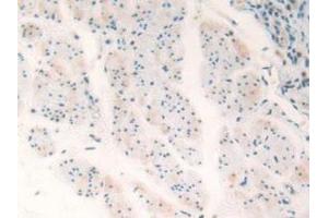 Detection of TP53TG5 in Human Esophagus Cancer Tissue using Polyclonal Antibody to TP53 Target Gene 5 (TP53TG5)