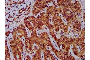 IHC image of ABIN7154731 diluted at 1:400 and staining in paraffin-embedded human liver cancer performed on a Leica BondTM system.