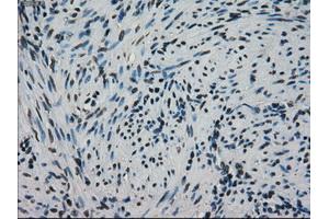 Immunohistochemical staining of paraffin-embedded Adenocarcinoma of ovary tissue using antiHSPA9mouse monoclonal antibody.