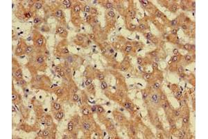 Immunohistochemistry of paraffin-embedded human liver cancer using ABIN7162738 at dilution of 1:100 (GIPC1 anticorps  (AA 7-74))