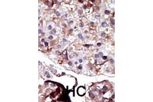 Formalin-fixed and paraffin-embedded human hepatocellular carcinoma tissue reacted with SPHK2 polyclonal antibody  , which was peroxidase-conjugated to the secondary antibody, followed by AEC staining. (SPHK2 anticorps  (N-Term))