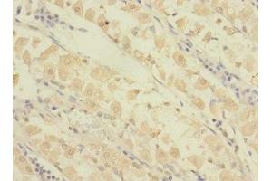 Immunohistochemistry of paraffin-embedded human gastric cancer using ABIN7154384 at dilution of 1:100 (GRAMD1B anticorps  (AA 235-504))