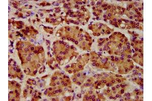 IHC image of ABIN7151354 diluted at 1:1000 and staining in paraffin-embedded human pancreatic cancer performed on a Leica BondTM system.