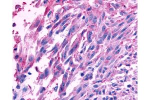 Anti-FZD10 / Frizzled 10 antibody IHC of human Skin, Melanoma.