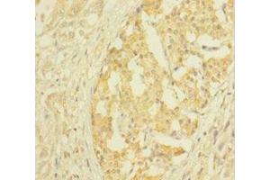 Immunohistochemistry of paraffin-embedded human pancreatic cancer using ABIN7147859 at dilution of 1:100 (CLTB anticorps  (AA 1-211))