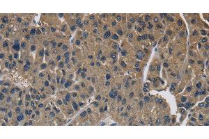Immunohistochemistry of paraffin-embedded Human liver cancer using SIGMAR1 Polyclonal Antibody at dilution of 1:50 (SIGMAR1 anticorps)