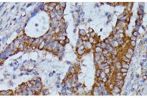 Immunohistochemistry of paraffin-embedded Human colon carcinoma using HMGCS2 Polyclonal Antibody at dilution of 1:100 (40x lens). (HMGCS2 anticorps)