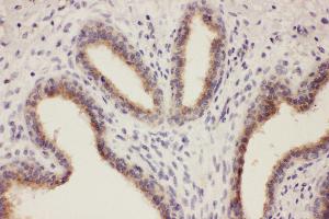 Anti-RTN3 antibody, IHC(P) IHC(P): Human Mammary Cancer Tissue (Reticulon 3 anticorps  (C-Term))