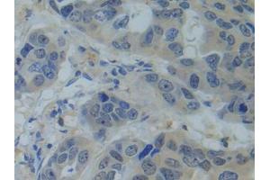 IHC-P analysis of Human Breast cancer Tissue, with DAB staining. (SNRPC anticorps  (AA 2-159))