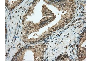 Immunohistochemical staining of paraffin-embedded Adenocarcinoma of Human ovary tissue using anti-PDE4A mouse monoclonal antibody. (PDE4A anticorps)