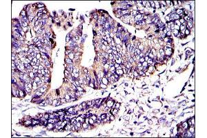 Immunohistochemical analysis of paraffin-embedded rectum cancer tissues using CRK mouse mAb with DAB staining.