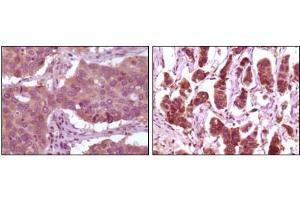 Immunohistochemical analysis of paraffin-embedded human lung carcinoma (left) and breast carcinoma (right) showing cytoplasmic localization using ERK2 mouse mAb with DAB staining.