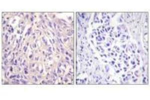 Immunohistochemistry analysis of paraffin-embedded human breast carcinoma tissue using UBE1L antibody. (UBA7 anticorps  (C-Term))