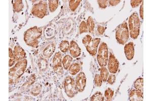 IHC-P Image Immunohistochemical analysis of paraffin-embedded human gastric cancer, using Cathepsin O, antibody at 1:100 dilution.