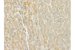 ABIN6266258 and ABIN6277419 at 1/100 staining human hepatocellular carcinoma by IHC-P. (P2RY11 anticorps  (C-Term))