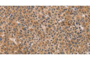 Immunohistochemistry of paraffin-embedded Human liver cancer using CDK11B Polyclonal Antibody at dilution of 1:40 (CDK11 anticorps)