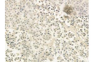 ABIN6260386 and ABIN6279208 at 1/100 staining human pituitary adenoma by IHC-P. (CABIN1 anticorps  (Internal Region))