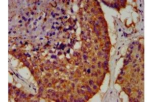 IHC image of ABIN7164068 diluted at 1:100 and staining in paraffin-embedded human lung cancer performed on a Leica BondTM system.