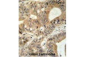 ABCC3 antibody (Center) immunohistochemistry analysis in formalin fixed and paraffin embedded human colon carcinoma followed by peroxidase conjugation of the secondary antibody and DAB staining.