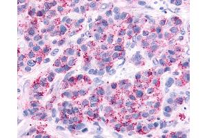 Anti-AVPR2 / V2R antibody IHC of human Breast, Carcinoma. (AVPR2 anticorps  (Cytoplasmic Domain))