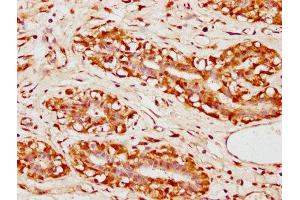 IHC image of ABIN7152644 diluted at 1:300 and staining in paraffin-embedded human breast cancer performed on a Leica BondTM system.