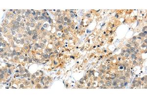 Immunohistochemistry of paraffin-embedded Human liver cancer tissue using KCNG3 Polyclonal Antibody at dilution 1:40 (KCNG3 anticorps)