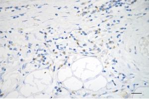 Immunohistochemistry was performed on paraffin-embedded human sigmoid colon carcinoma using ADAM17 antibody (ABIN7797502), 1:200). (Recombinant ADAM17 anticorps)