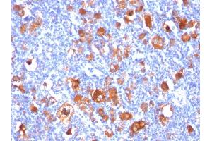 Formalin-fixed, paraffin-embedded human Hodgkin's Lymphoma stained with Fascin-1 Mouse Monoclonal Antibody (FSCN1/418). (Fascin anticorps)